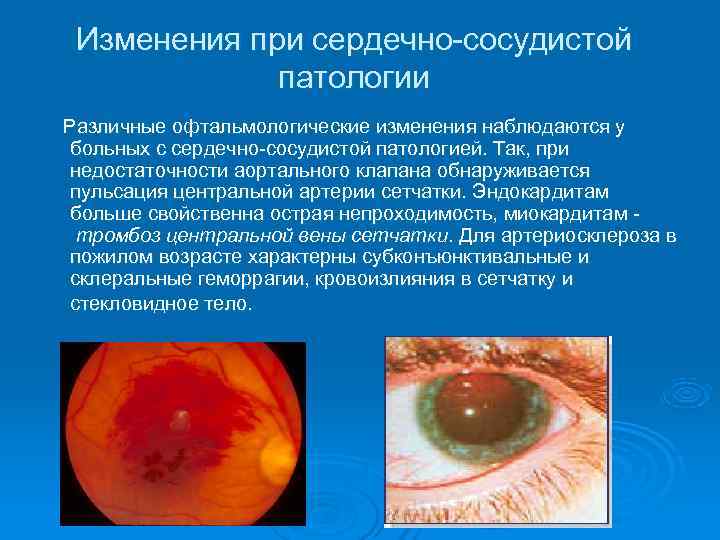   Изменения при сердечно-сосудистой   патологии  Различные офтальмологические изменения наблюдаются у