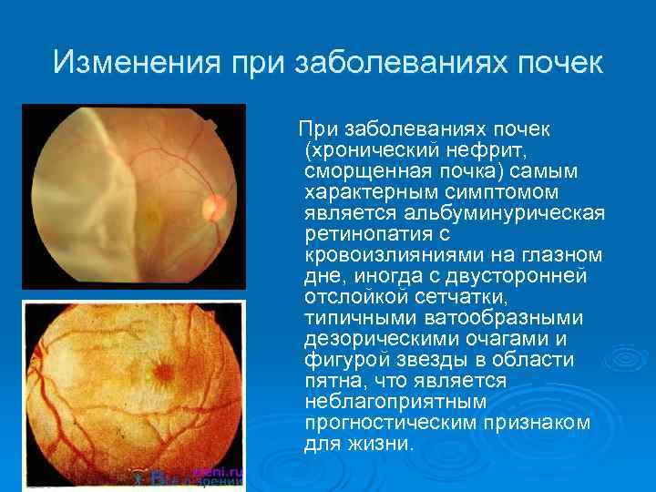 Изменения при заболеваниях почек   При заболеваниях почек   (хронический нефрит, 