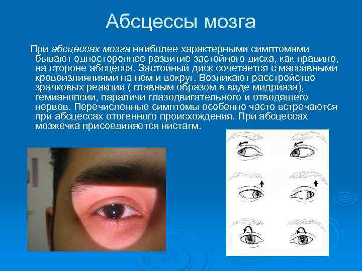    Абсцессы мозга  При абсцессах мозга наиболее характерными симптомами бывают одностороннее