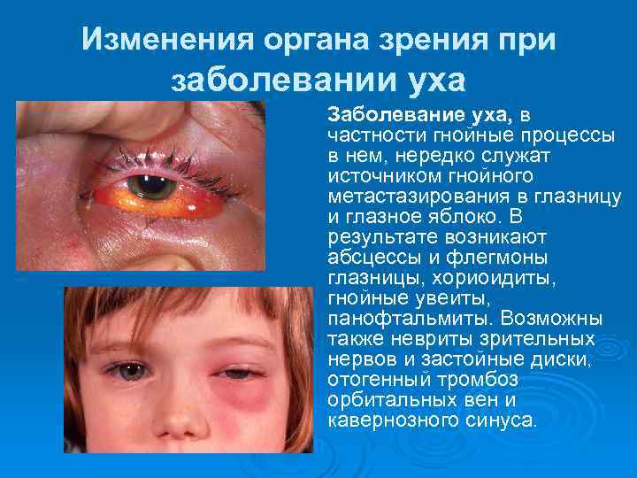 Изменения органа зрения при заболевании уха   Заболевание уха, в   