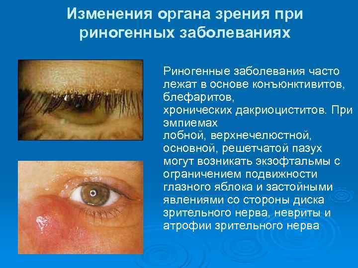 Изменения органа зрения при риногенных заболеваниях  Риногенные заболевания часто  лежат в основе