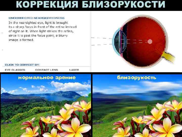 КОРРЕКЦИЯ БЛИЗОРУКОСТИ нормальное зрение  близорукость 
