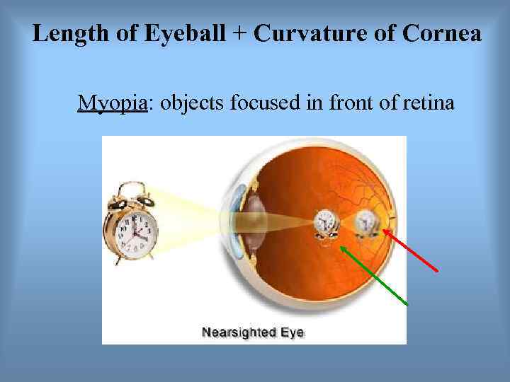 Length of Eyeball + Curvature of Cornea Myopia: objects focused in front of retina