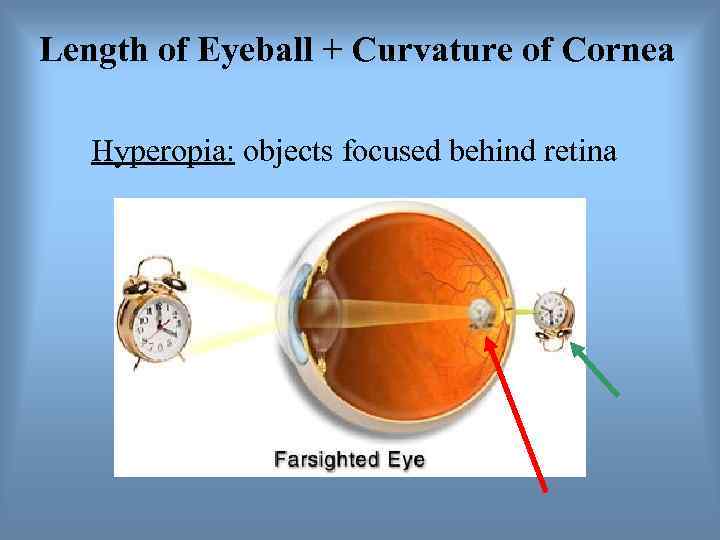 Length of Eyeball + Curvature of Cornea Hyperopia: objects focused behind retina 