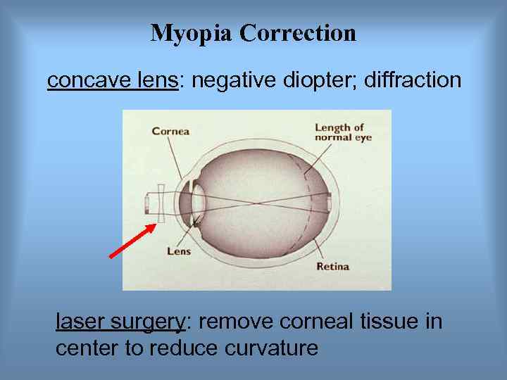    Myopia Correction concave lens: negative diopter; diffraction laser surgery: remove corneal