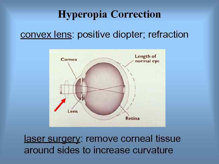    Hyperopia Correction convex lens: positive diopter; refraction laser surgery: remove corneal
