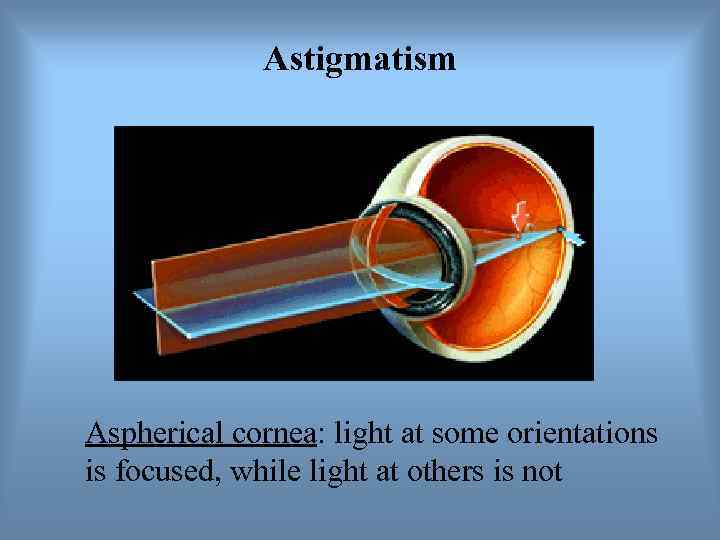    Astigmatism Aspherical cornea: light at some orientations is focused, while light