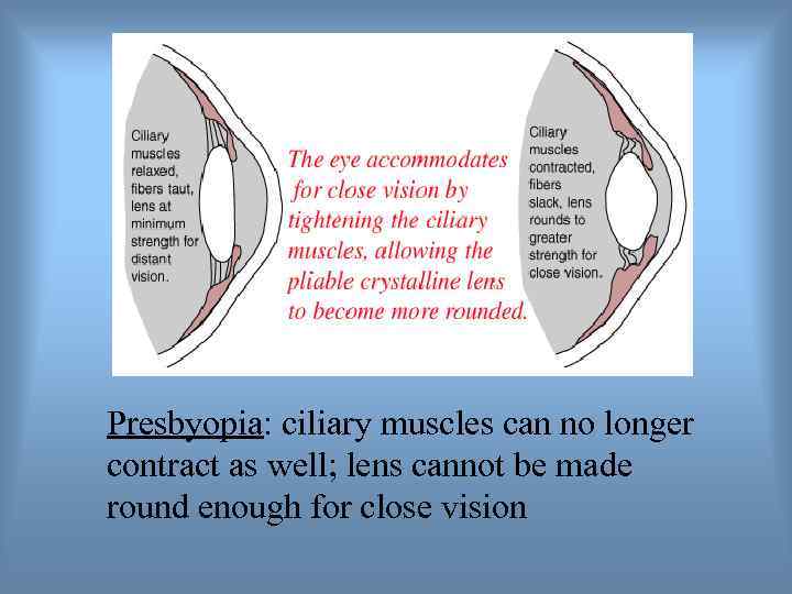 Presbyopia: ciliary muscles can no longer contract as well; lens cannot be made round