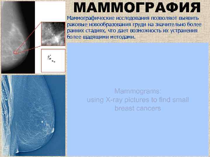 Маммография в арзамасе. Маммографические исследования. Маммография памятка.