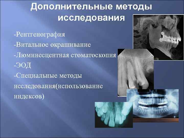   Дополнительные методы   исследования -Рентгенография -Витальное окрашивание -Люминесцентная стоматоскопия -ЭОД -Специальные