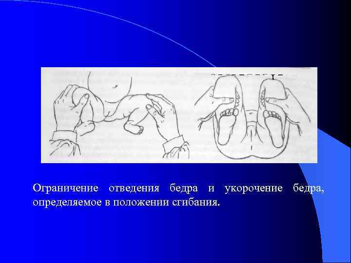 Ограничение отведения бедра и укорочение бедра,  определяемое в положении сгибания.  