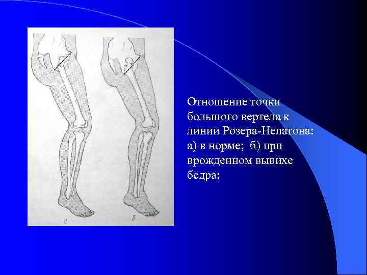 Схема врожденного вывиха бедра