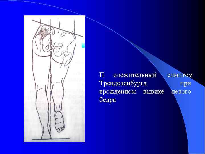 Для клинической картины врожденного вывиха бедра характерны симптомы