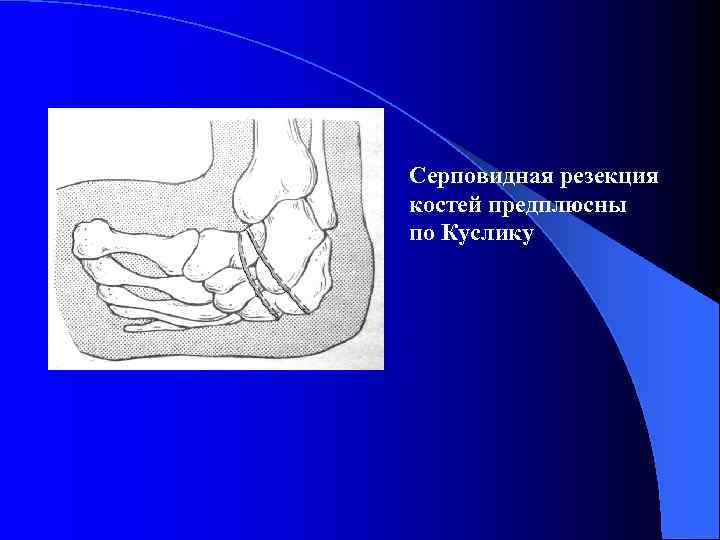 Серповидная резекция костей предплюсны по Куслику 