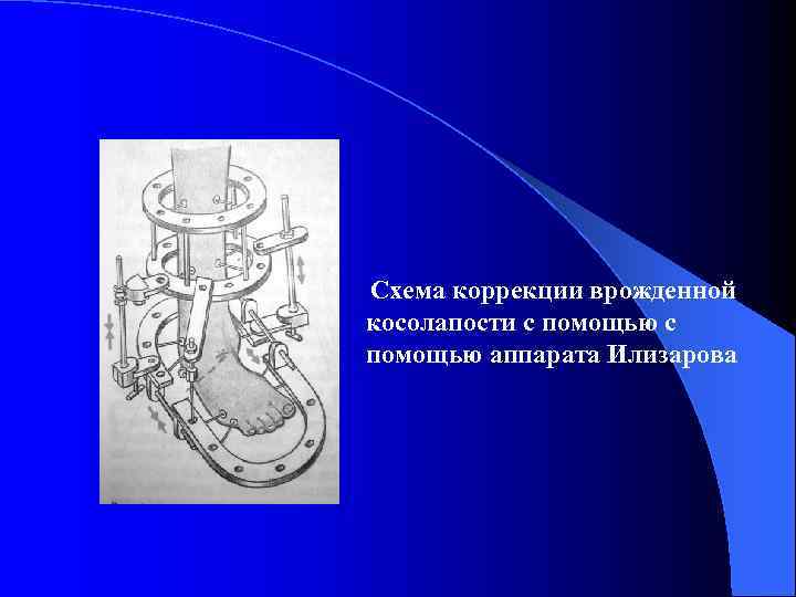 Схема коррекции врожденной  косолапости с помощью аппарата Илизарова 
