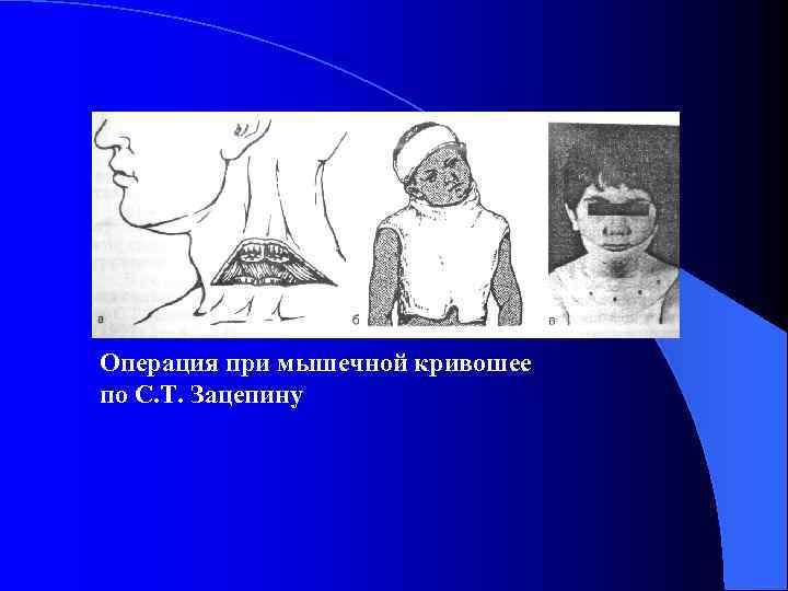 Операция при мышечной кривошее по С. Т. Зацепину 