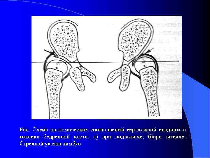 Рис.  Схема анатомических соотношений вертлужной впадины и головки бедренной кости:  а) при