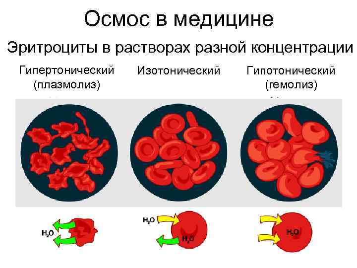   Осмос в медицине Эритроциты в растворах разной концентрации Гипертонический  Изотонический 