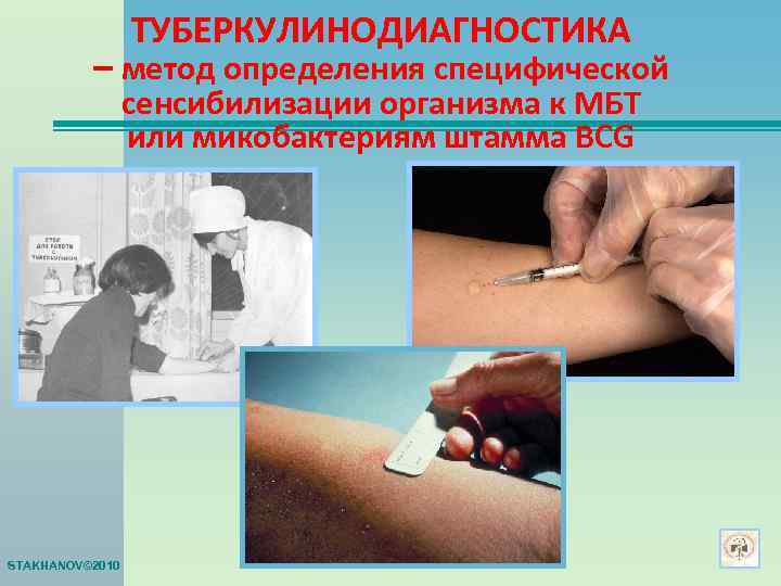   ТУБЕРКУЛИНОДИАГНОСТИКА  – метод определения специфической   сенсибилизации организма к