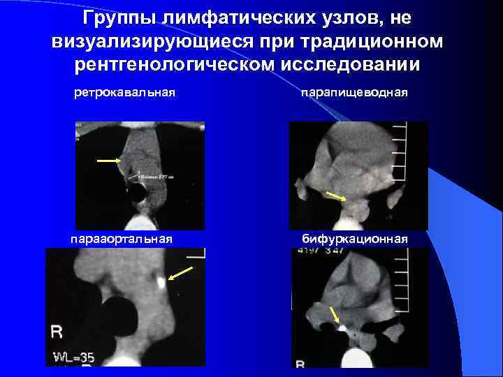   Группы лимфатических узлов, не визуализирующиеся при традиционном  рентгенологическом исследовании ретрокавальная парапищеводная