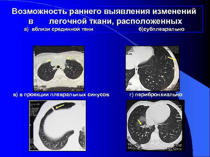 Возможность раннего выявления изменений  в  легочной ткани, расположенных  а) вблизи срединной