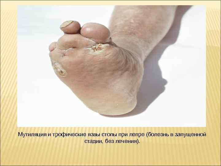 Мутиляция и трофические язвы стопы при лепре (болезнь в запущенной    стадии,