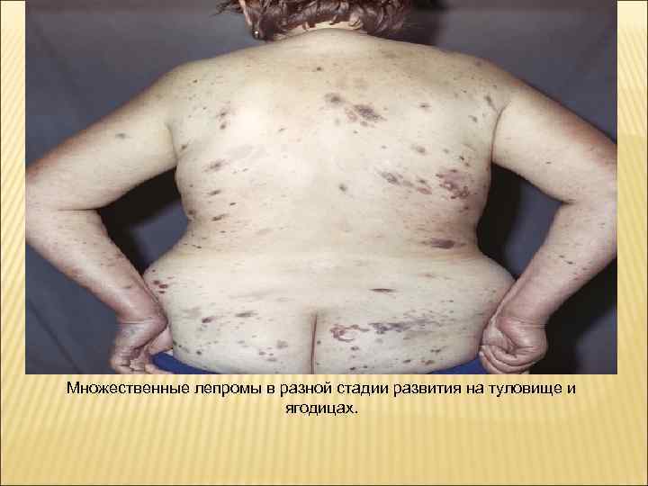 Множественные лепромы в разной стадии развития на туловище и     ягодицах.