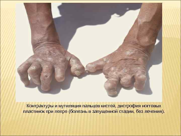  Контрактуры и мутиляция пальцев кистей, дистрофия ногтевых пластинок при лепре (болезнь в запущенной