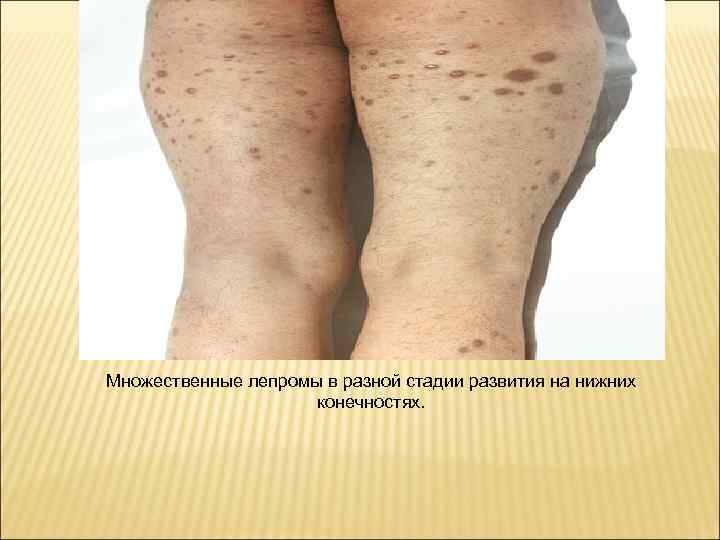 Множественные лепромы в разной стадии развития на нижних     конечностях. 