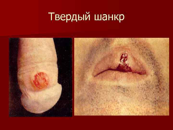 Твердый шанкр 