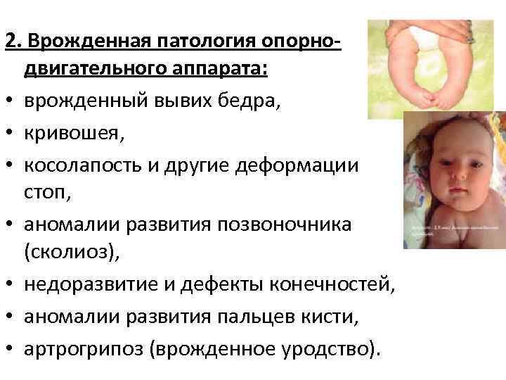 2. Врожденная патология опорно-  двигательного аппарата:  • врожденный вывих бедра,  •