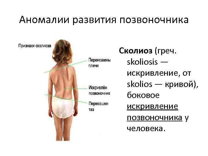 Аномалии развития позвоночника    Сколиоз (греч.     skoliosis —