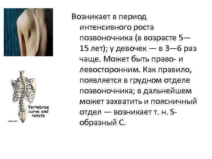 Возникает в период  интенсивного роста  позвоночника (в возрасте 5—  15 лет);