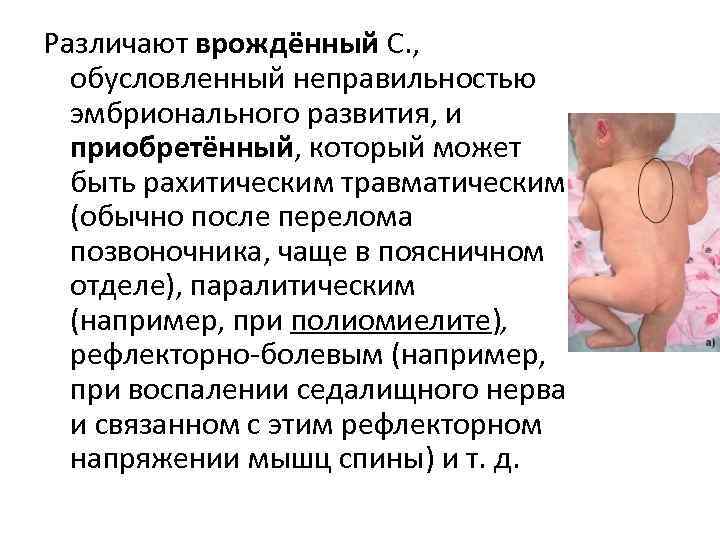 Различают врождённый С. , обусловленный неправильностью  эмбрионального развития, и  приобретённый, который может