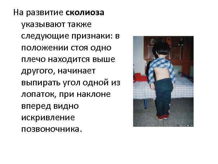 На развитие сколиоза  указывают также  следующие признаки: в  положении стоя одно