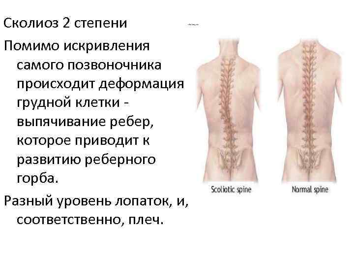 Сколиоз 2 степени Помимо искривления  самого позвоночника  происходит деформация  грудной клетки