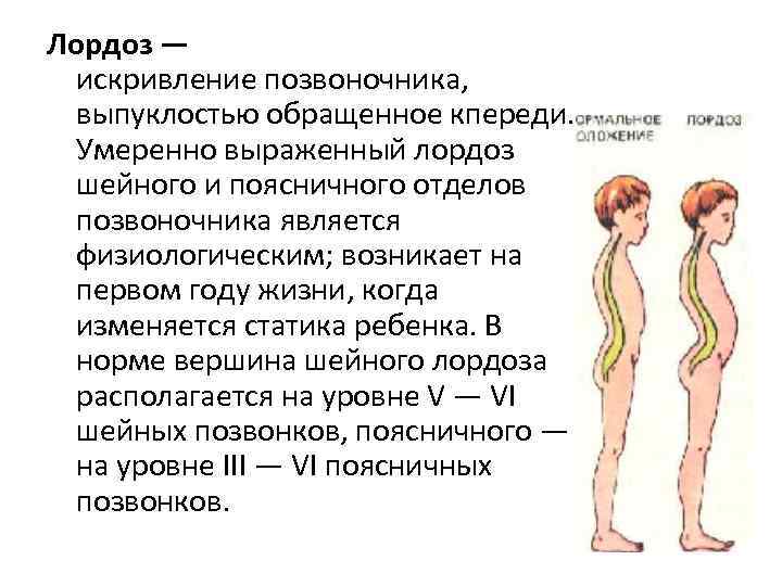 Лордоз —  искривление позвоночника, выпуклостью обращенное кпереди. Умеренно выраженный лордоз  шейного и