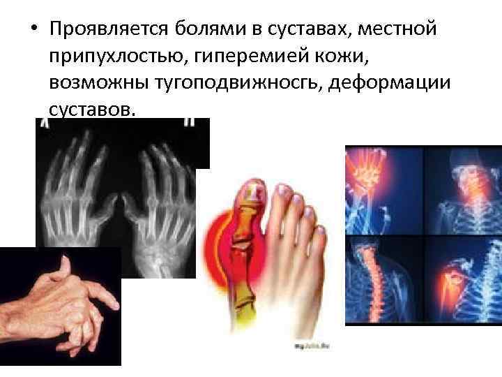  • Проявляется болями в суставах, местной  припухлостью, гиперемией кожи, возможны тугоподвижносгь, деформации