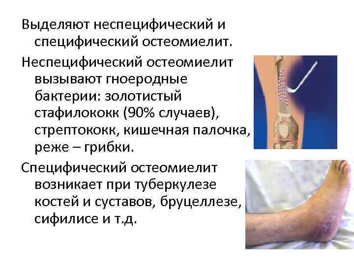 Выделяют неспецифический и  специфический остеомиелит. Неспецифический остеомиелит  вызывают гноеродные  бактерии: золотистый