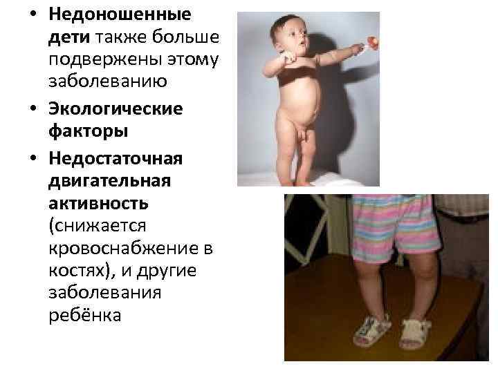  • Недоношенные  дети также больше  подвержены этому  заболеванию • Экологические