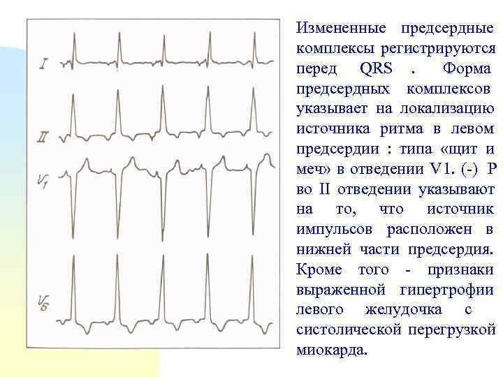 Измененные предсердные комплексы регистрируются перед QRS.   Форма предсердных комплексов указывает на локализацию