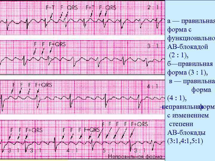  а — правильная  форма с  функционально  АВ-блокадой  (2 :