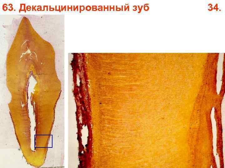63. Декальцинированный зуб 34. 63. Декальцинированный зуб 34.