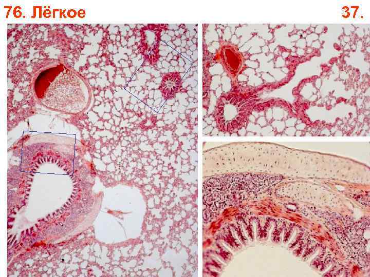 76. Лёгкое 37. 76. Лёгкое 37.