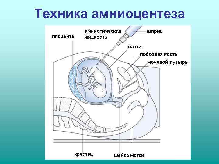 Техника амниоцентеза 