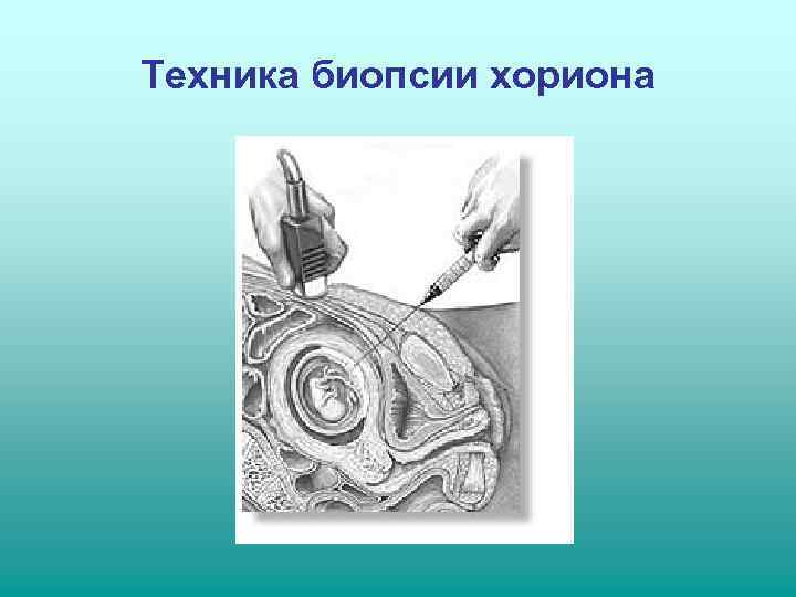 Техника биопсии хориона 