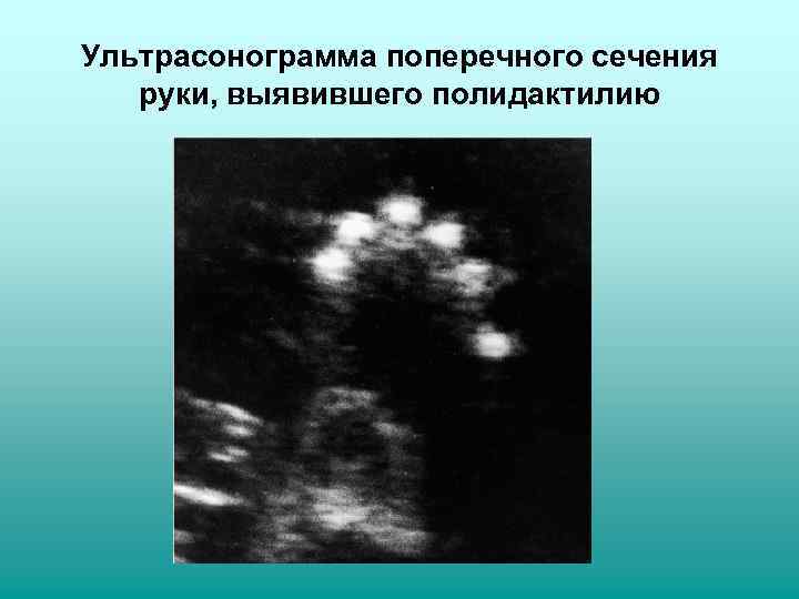 Ультрасонограмма поперечного сечения  руки, выявившего полидактилию 