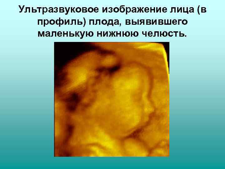 Ультразвуковое изображение лица (в  профиль) плода, выявившего  маленькую нижнюю челюсть. 