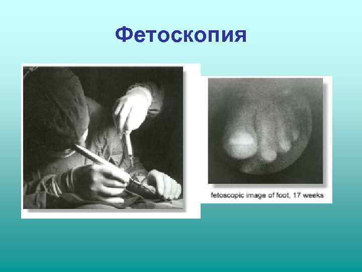 Фетоскопия 