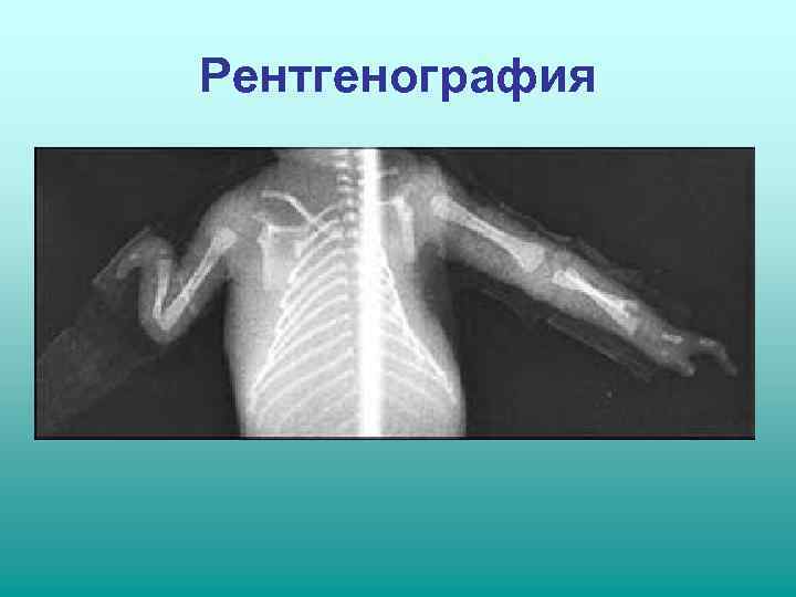 Рентгенография 